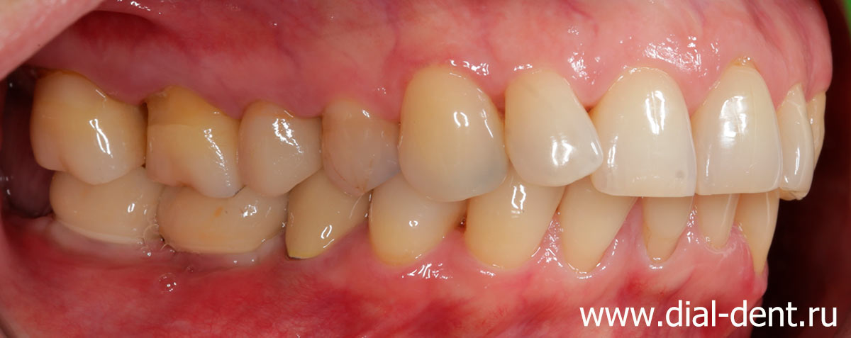 протезирование зубов на имплантах завершено