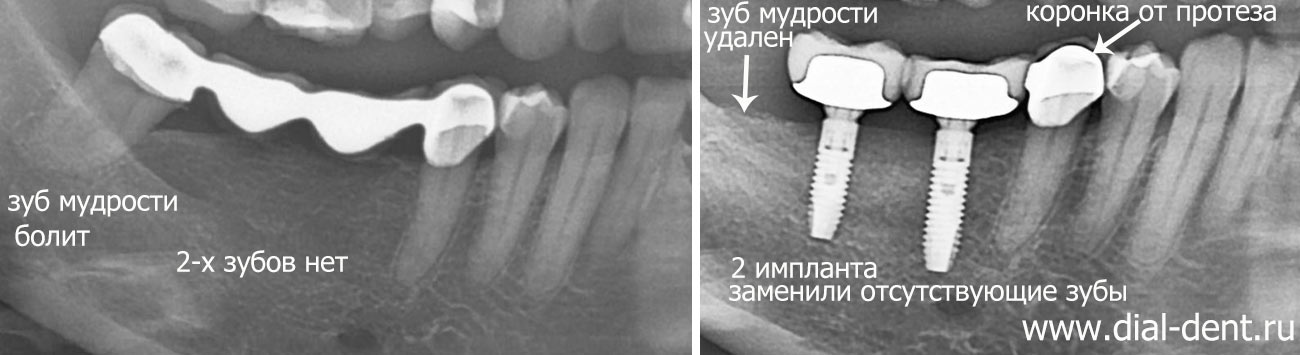 удален зуб, мостовидный протез заменен коронками на имплантах