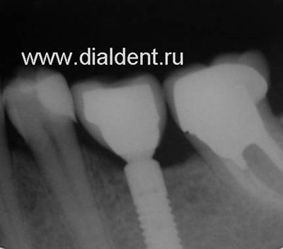 Имплантация зубов - лучший метод восстановления отсутствующего зуба