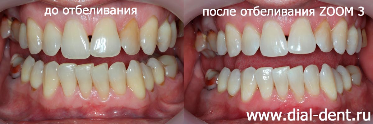 до и после отбеливания зубов zoom 3