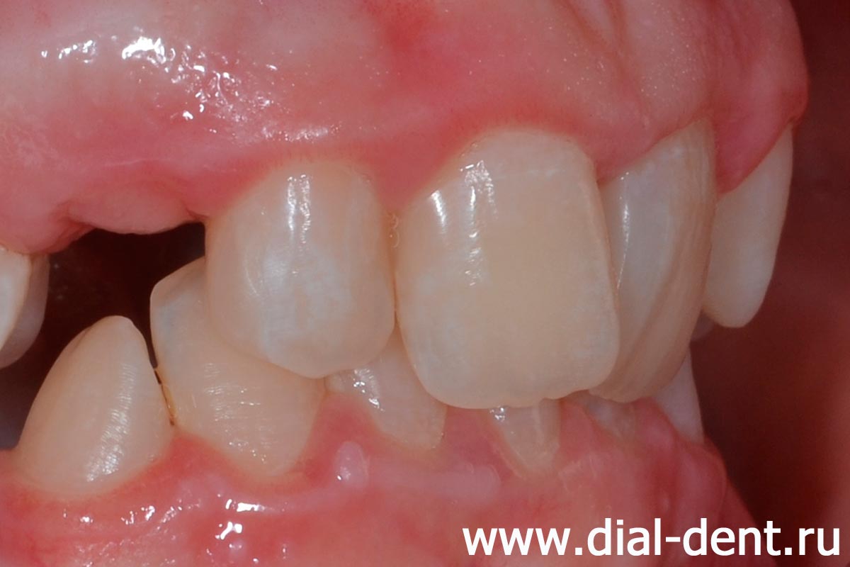 пломбы на передних зубах после лечения кариеса