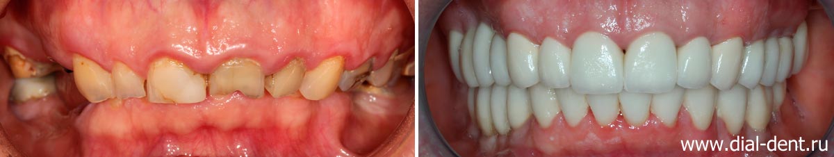вид зубов до и после лечения в Диал-Дент