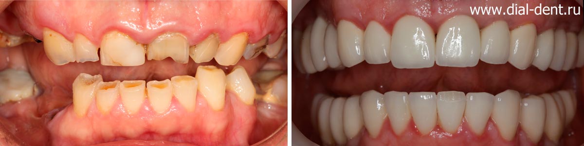 вид зубов до и после лечения в Диал-Дент