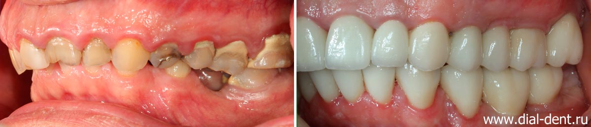 вид зубов слева до и после лечения в Диал-Дент