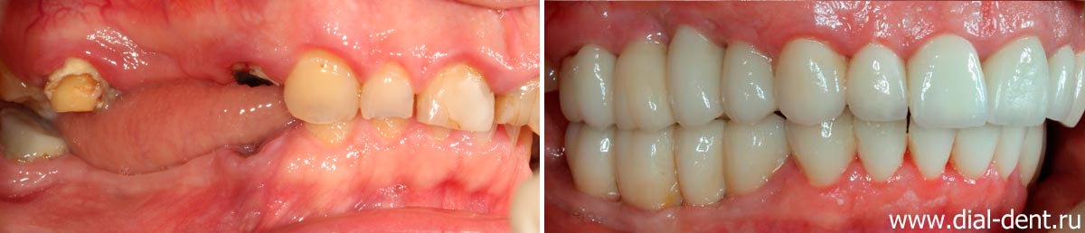 вид зубов справа до и после лечения в Диал-Дент