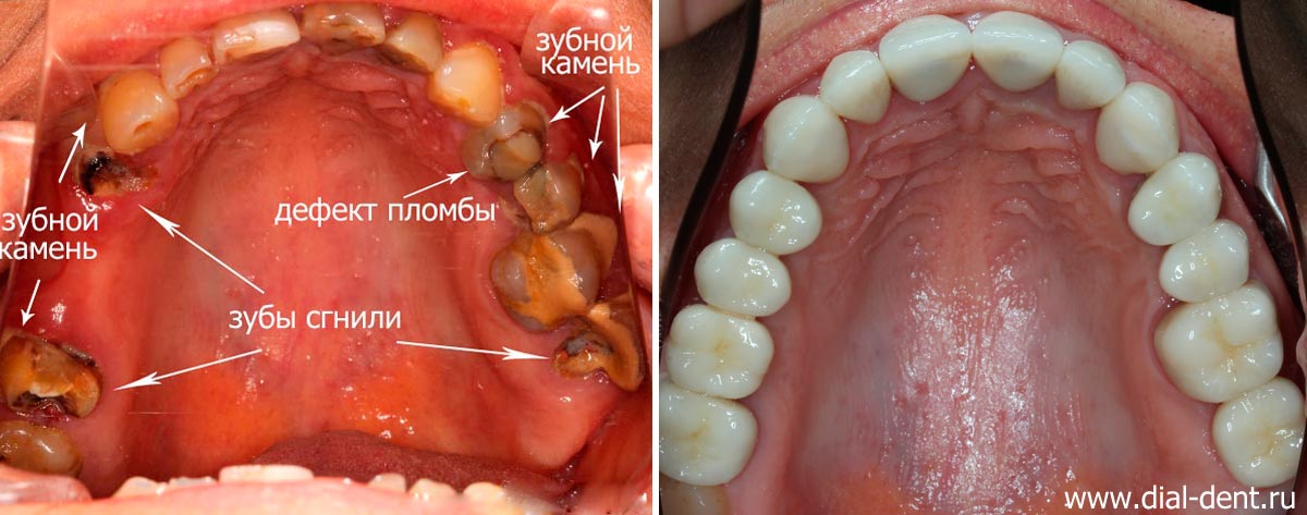 вид верхних зубов до и после лечения в Диал-Дент