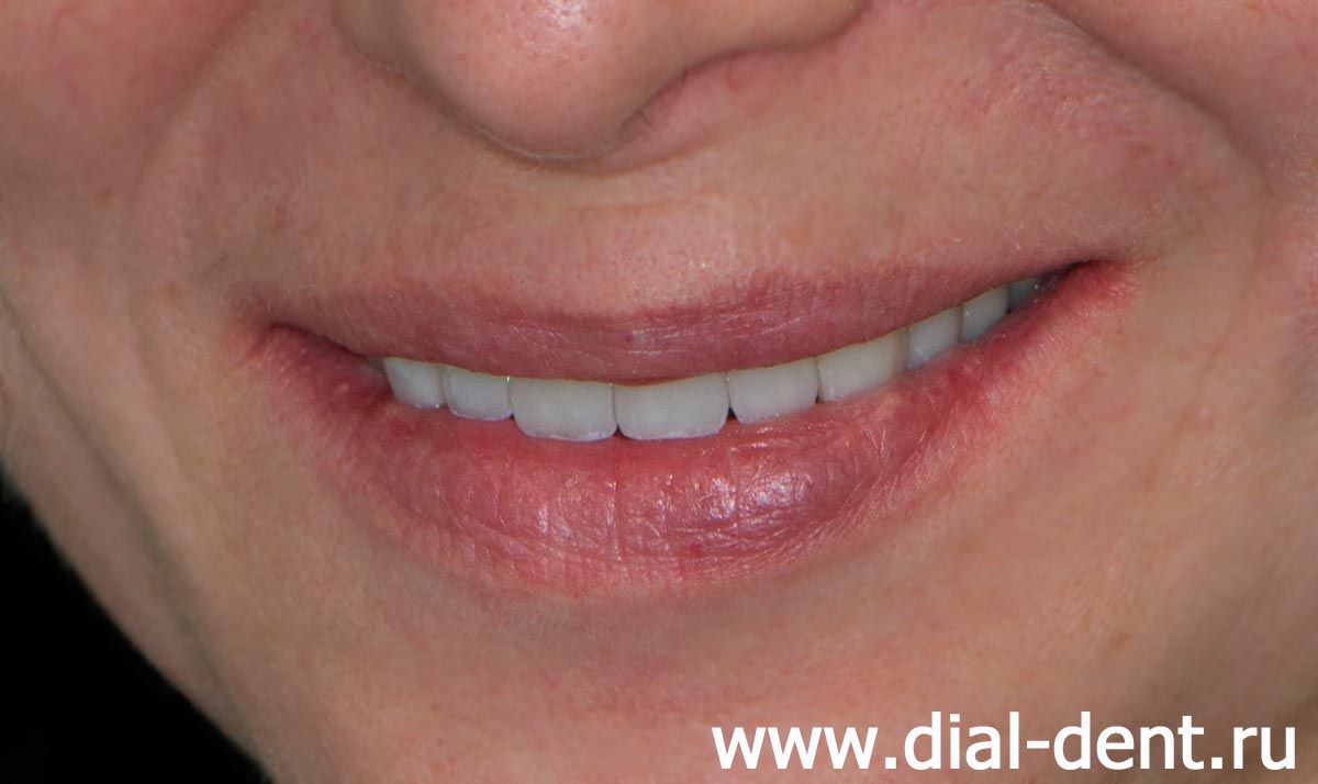 улыбка после комплексного лечения и протезирования зубов в Диал-Дент