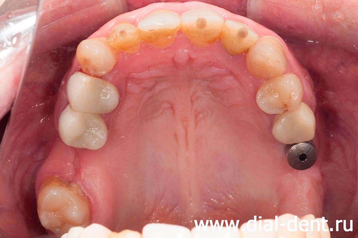 верхние зубы после лечения каналов, удаления зубов и одномоментной имплантации