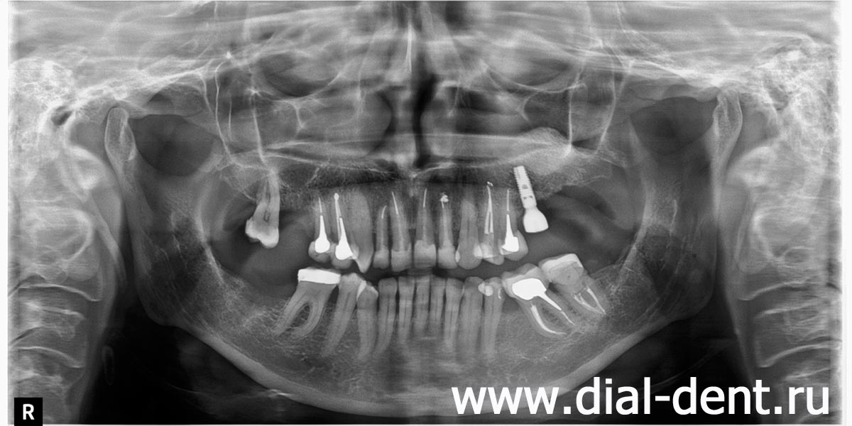 панорамный снимок после лечения каналов, удаления зубов и одномоментной имплантации