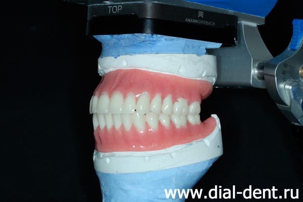 моделирование в артикуляторе протезирования зубов съемными протезами