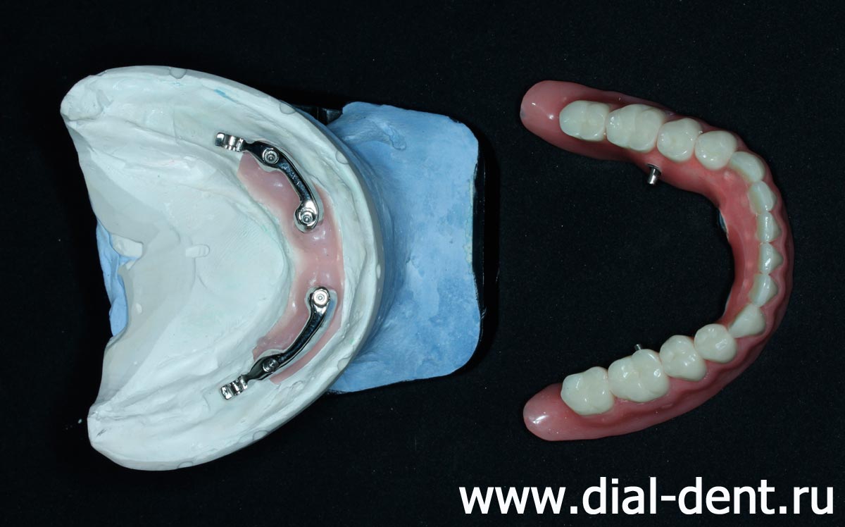 модель нижней челюсти и полный протез нижних зубов
