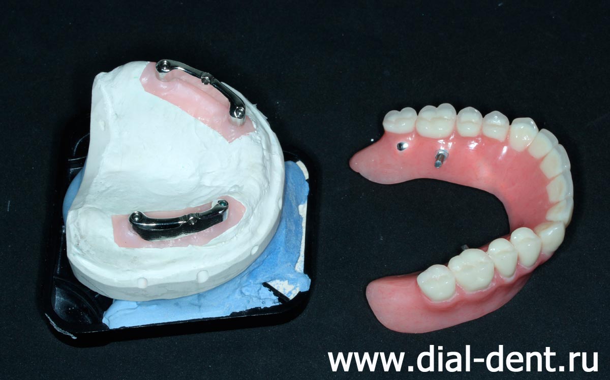 модель верхней челюсти и полный протез верхних зубов