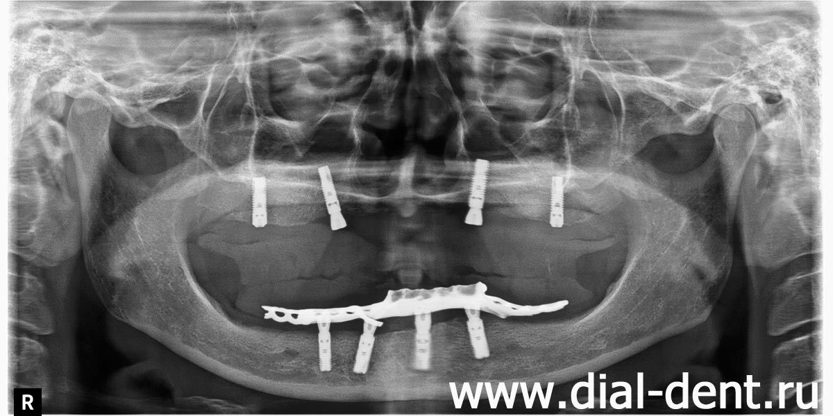 панорамный снимок после приживления зубных имплантов