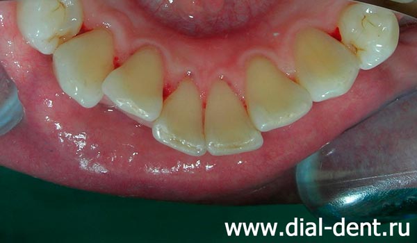 внутренняя поверхность нижхних зубов до чистки