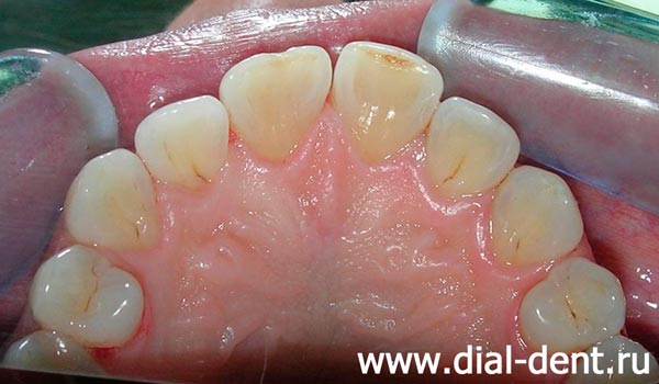 внутренняя поверхность верхних зубов до чистки