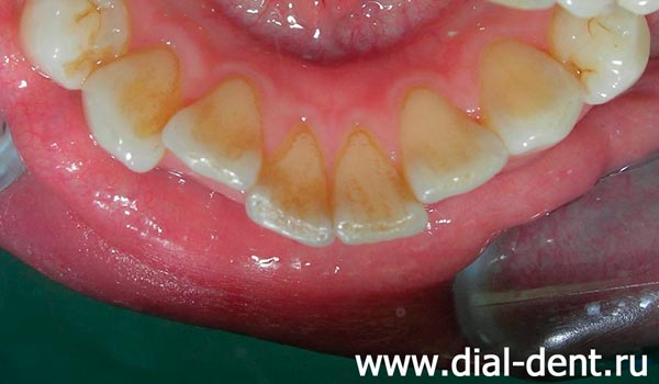 внутренняя поверхность нижхних зубов до чистки