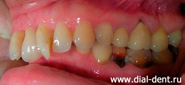 вид зубов слева до лечения