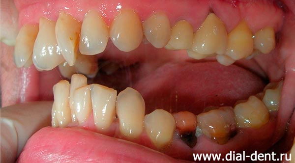 вид зубов слева до лечения