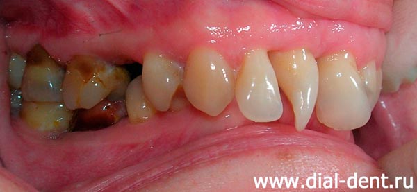 вид зубов справа до лечения