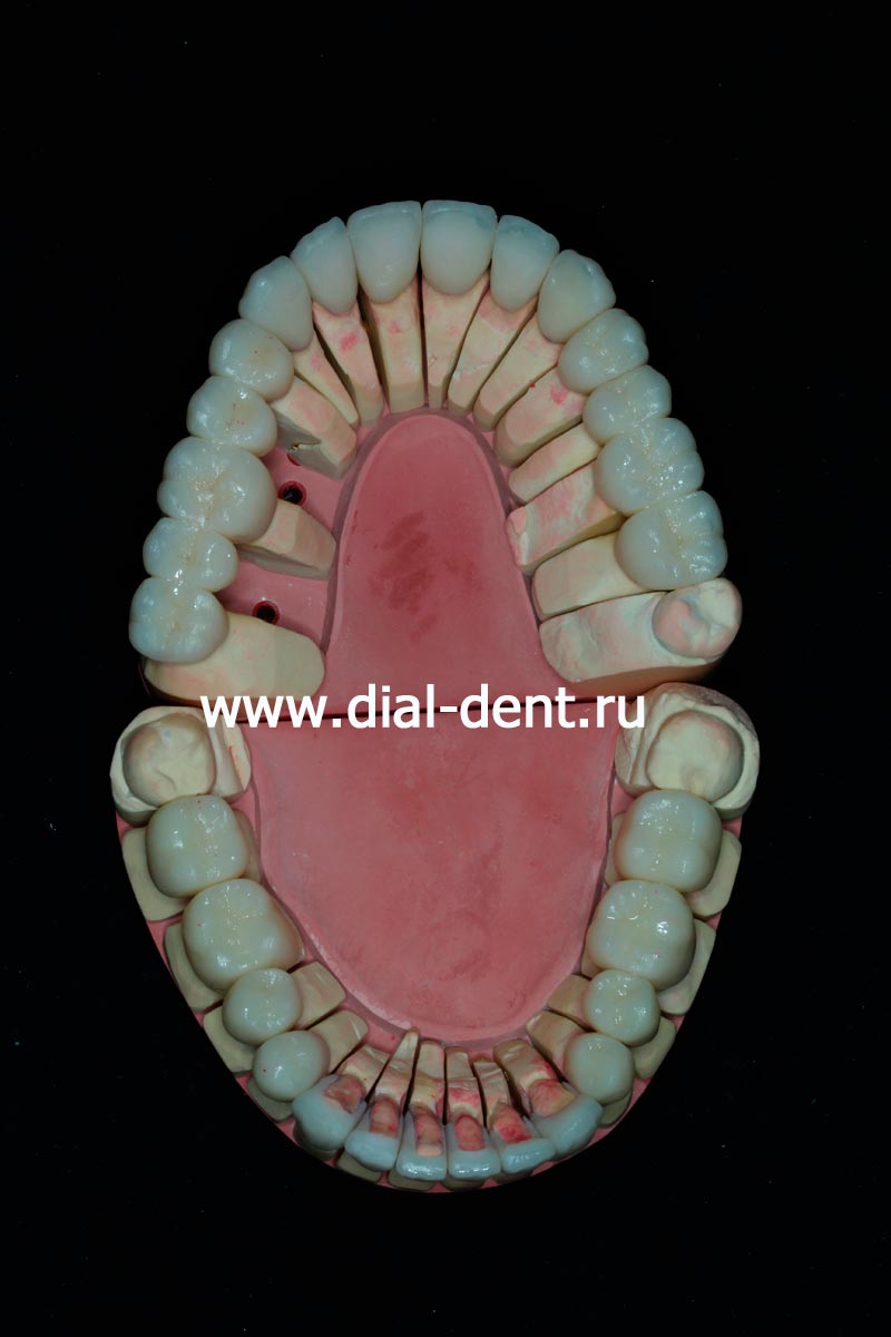 керамические зубные коронки на моделях челюстей