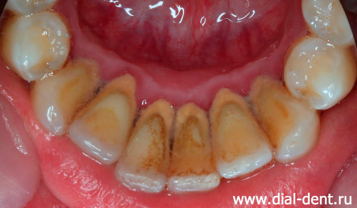 зубной камень на внутренней поверхности нижних зубов