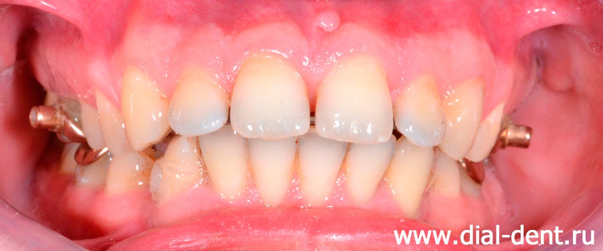через три месяца лечения брекетами заметно уменьшение щелей между верхними зубами и выравнивание нижних зубов
