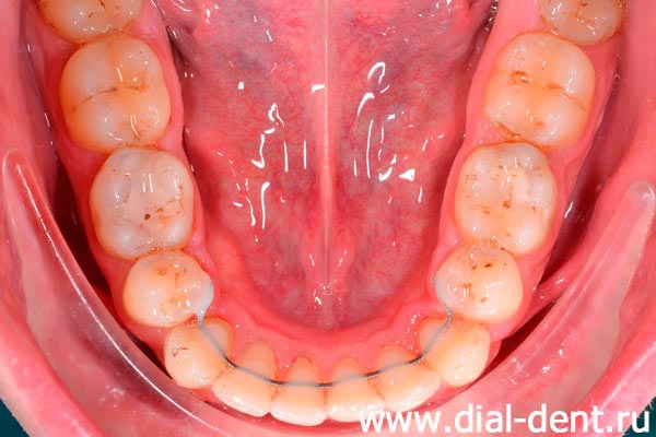 ретейнер на нижних зубах после окончания ортодонтического лечения