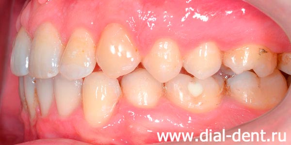 вид зубов слева после исправления прикуса в Диал-Дент