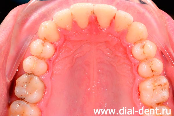 верхние зубы после окончания ортодонтического лечения
