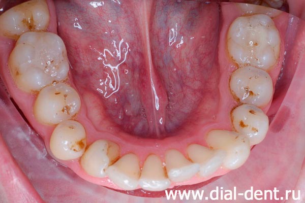 вид нижних зубов до ортодонтического лечения