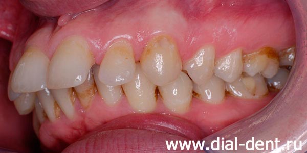 вид зубов слева до ортодонтического лечения