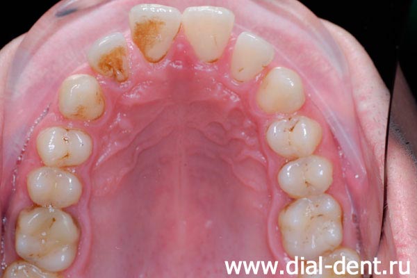 вид верхних зубов до ортодонтического лечения