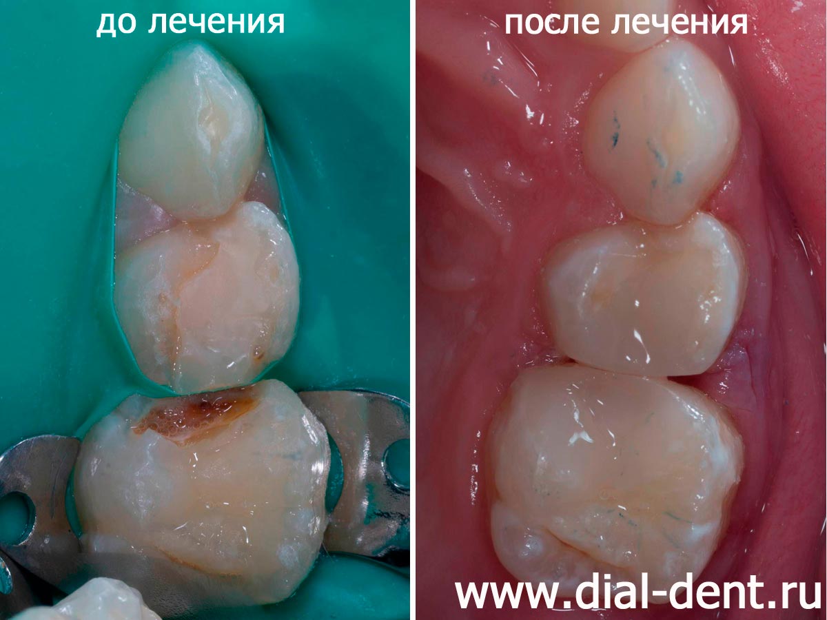 лечение пульпита молочного зуба и замена старой пломбы