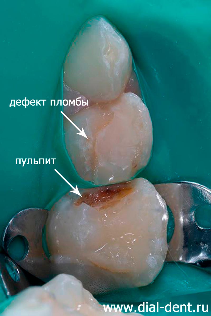пульпит молочного зуба, дефект пломбы
