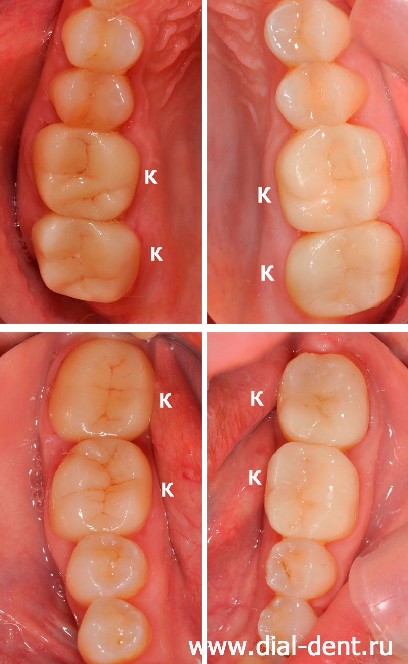 вылечен кариес, проведено лечение каналов, заменены старые пломбы, зубы отреставрированы коронками