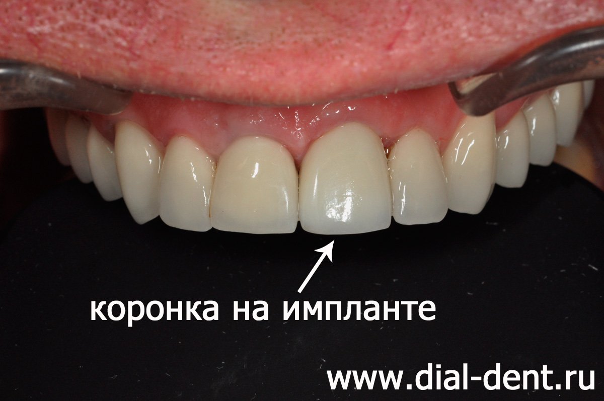 коронка на передний зуб зафиксирована