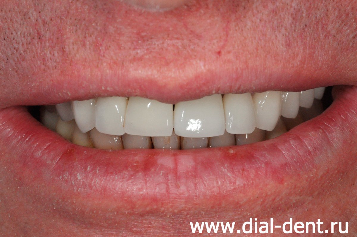 улыбка после протезирования на импланте переднего зуба