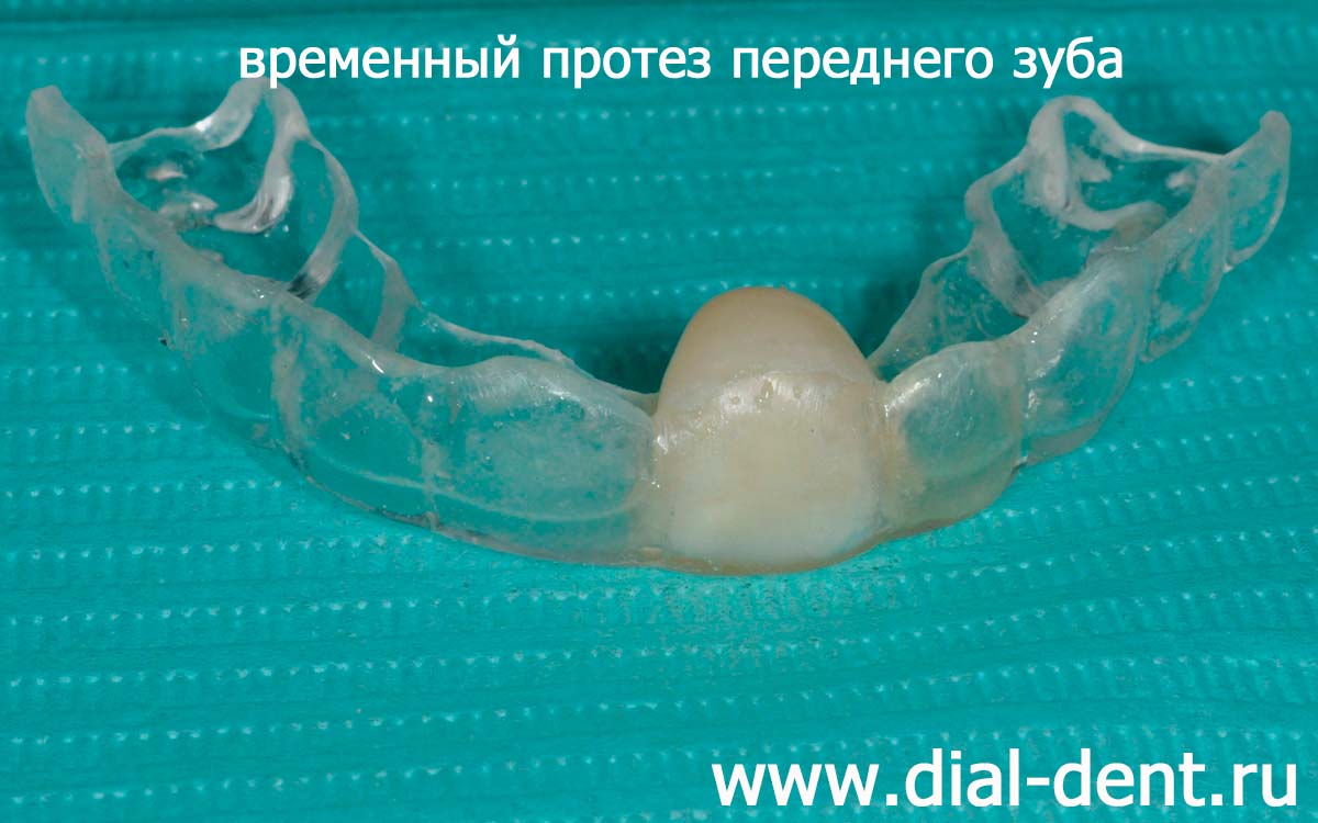 капа с искусственным зубом для замены удаленного переднего зуба