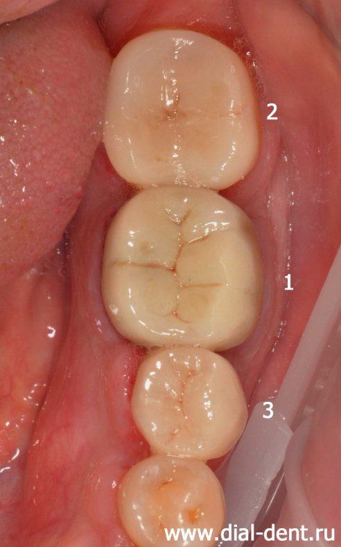 нижние зубы после протезирования керамическими коронками и вкладками