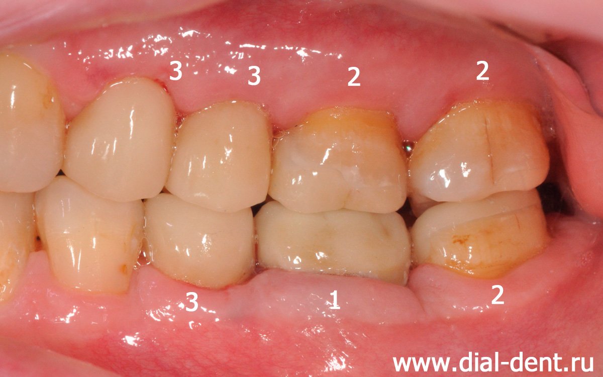 жевательные зубы после протезирования коронками и вкладками