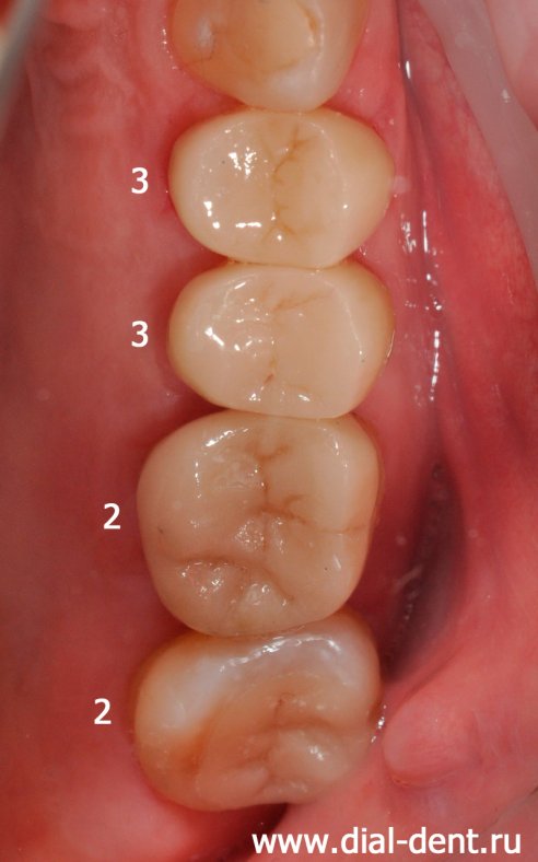 верхние зубы после протезирования керамическими коронками и вкладками