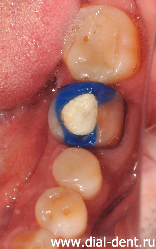 нижние зубы (разрушенный зуб временно восстановлен для лечения) со старыми пломбами