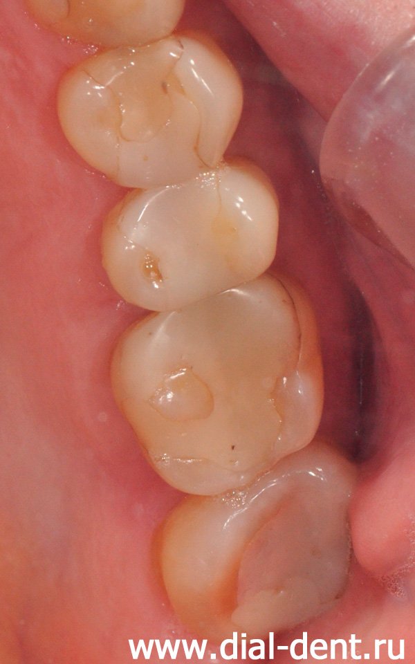 верхние зубы при обращении - старые массивные пломбы, сколы на зубах