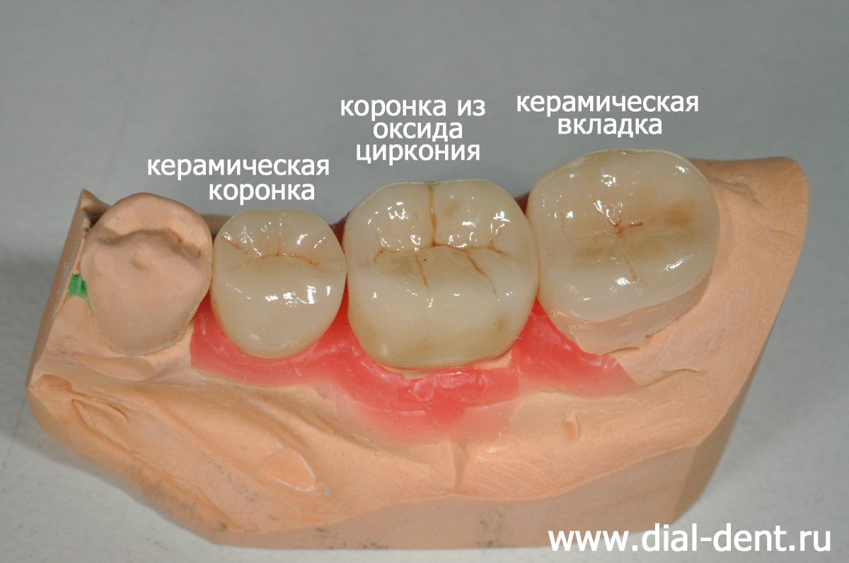 реставрации для нижних зубов на модели
