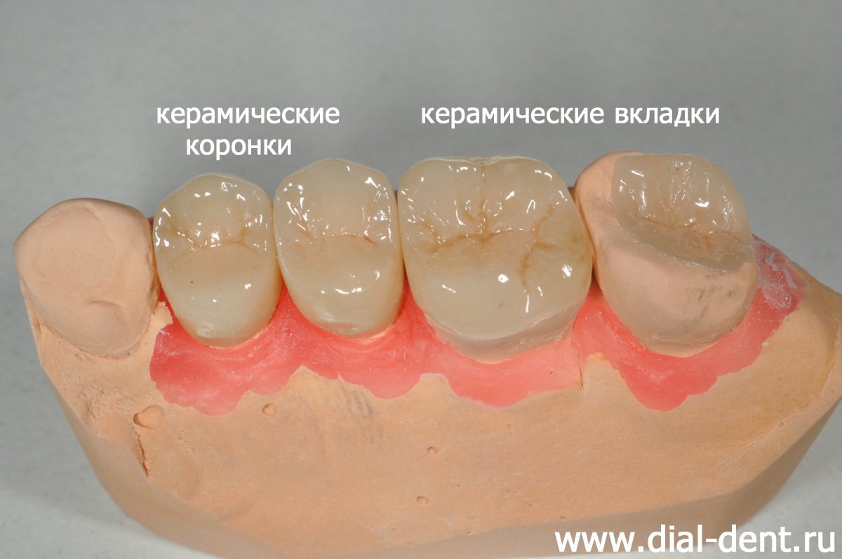 реставрации для верхних зубов на модели