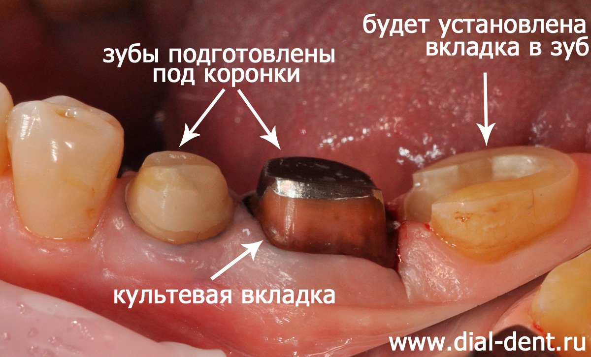 зубы подготовлены для реставрации вкладками и коронками