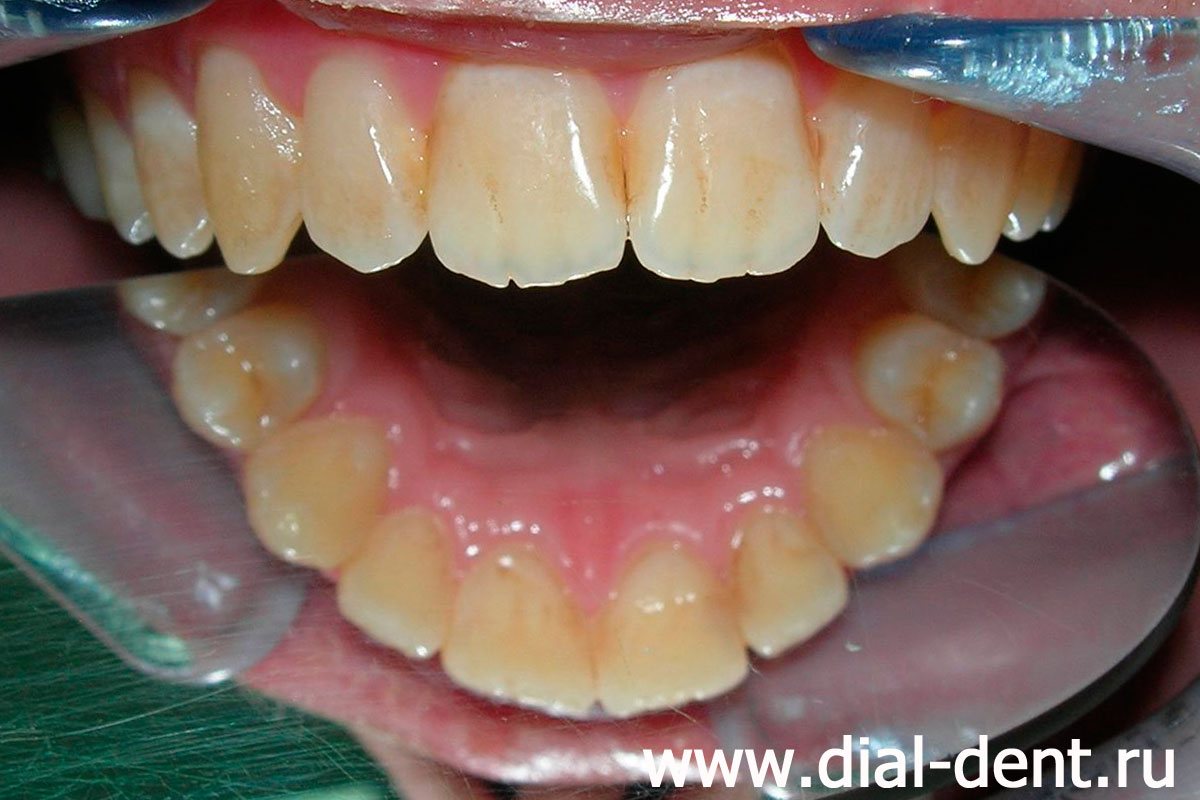 много зубного налета, зубной камень на внутренней стороне зубов вдоль десны