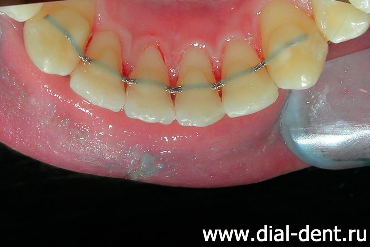 удален зубной камень и зубной налет в области ретейнера
