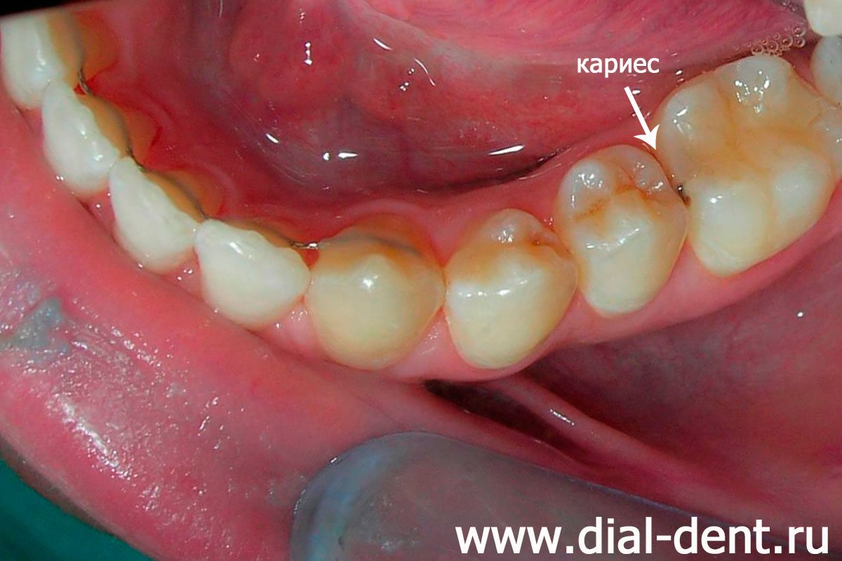 зубы после чистки, обнаружен кариес на контактной поверхности зубов
