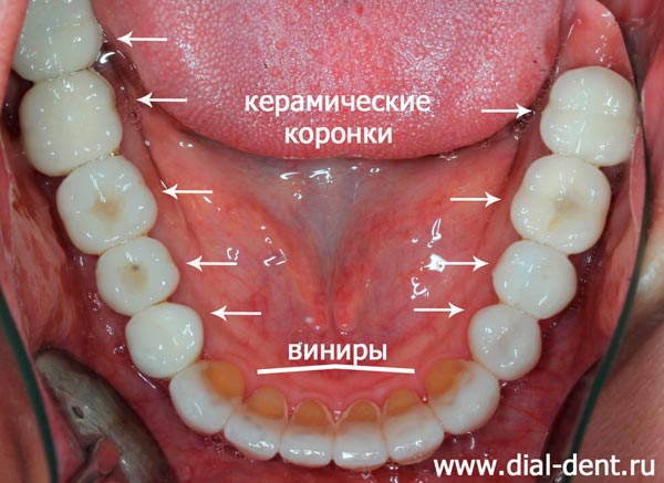 нижние зубы после лечения и протезирования зубов в Диал-Дент